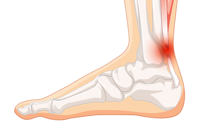 Illustration of an ankle wrapped in support bandage